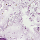 Image for article titled A Common Bacteria Can Be Injected Directly Into Tumors to Fight Cancer